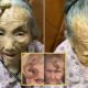 “This is too risky”: 107YO went viral because the 4-inch “Longevity Horn” growing on her forehead was said to be due to… see more